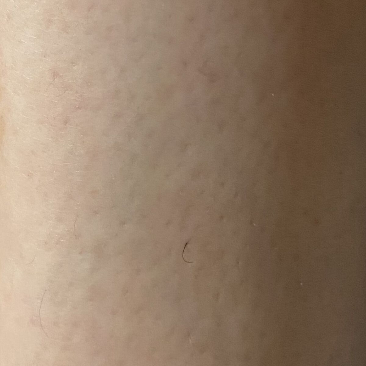 トリア・パーソナルレーザー脱毛器 4X/トリア/家庭用脱毛器を使ったクチコミ（2枚目）