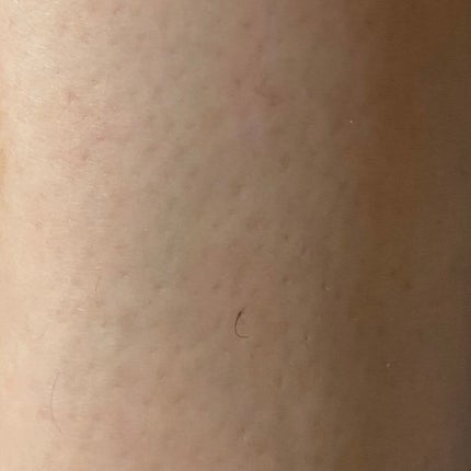 トリア・パーソナルレーザー脱毛器 4X/トリア/家庭用脱毛器を使ったクチコミ(2枚目)