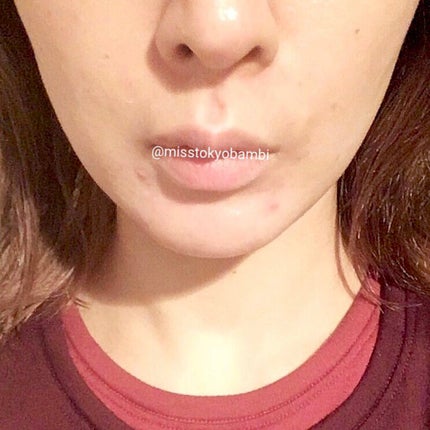 白ゆり@美容ブロガー on LIPS 「プラウドクリニックでほうれい線にヒアルロン酸注入してきたレポ✍..」(5枚目)