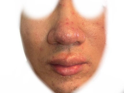 (フォロバ)3年後に韓国美男子 on LIPS 「CICA×HYALONフェスパック最終レビュー1ヶ月の経過写真..」(4枚目)