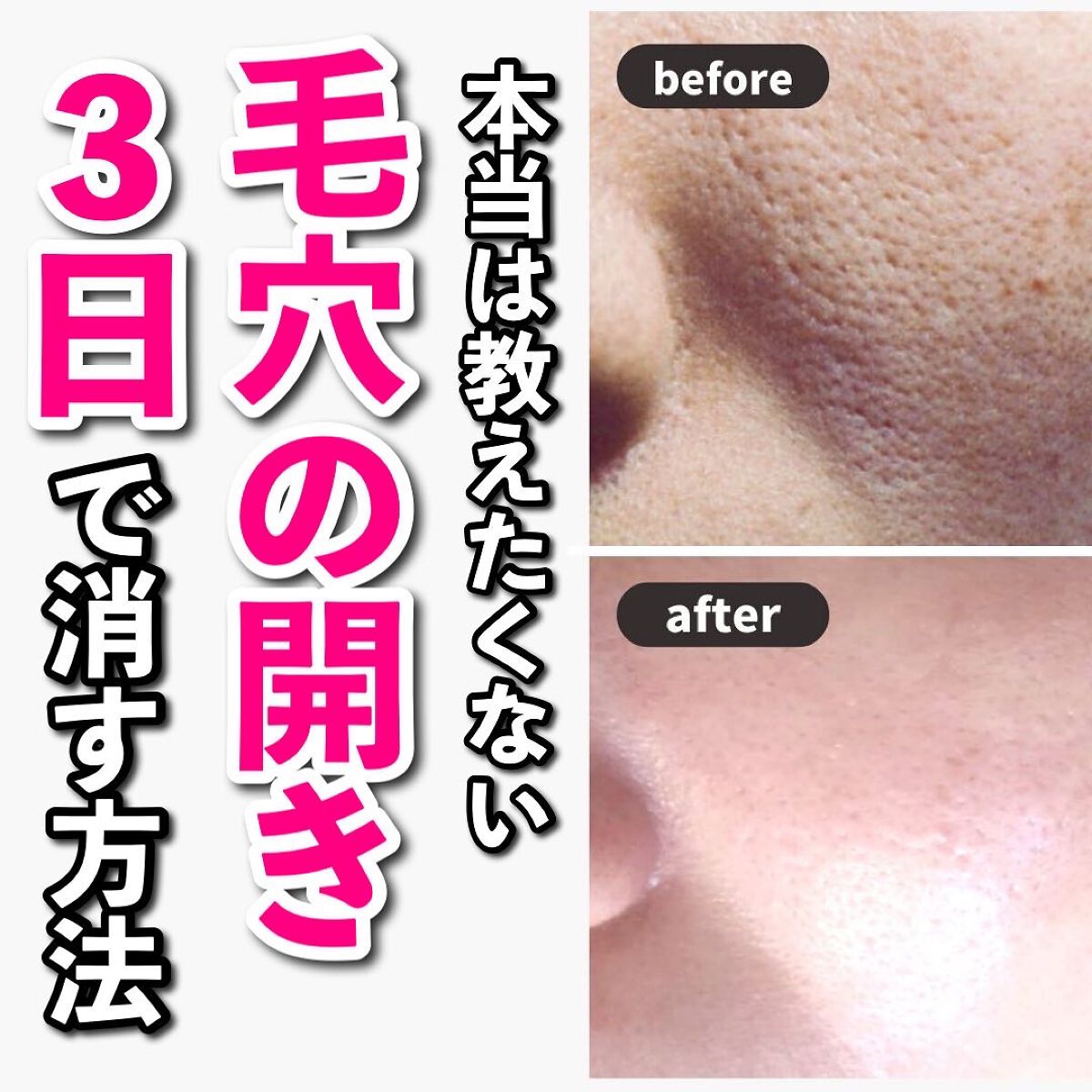 あなたの肌に合ったスキンケア💐コーくん先生 on LIPS 「【本当は教えたくない】毛穴の開き3日で消す方法.
.
あなたの..」(1枚目)