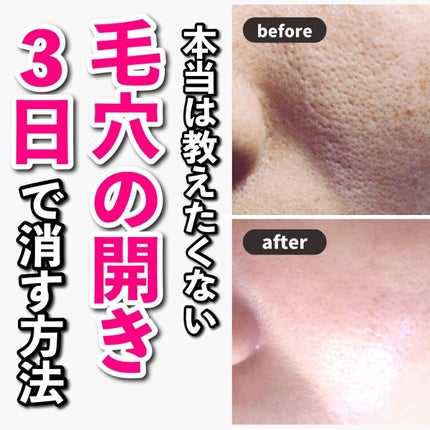 あなたの肌に合ったスキンケア💐コーくん先生 on LIPS 「【本当は教えたくない】毛穴の開き3日で消す方法.
.
あなたの..」(1枚目)