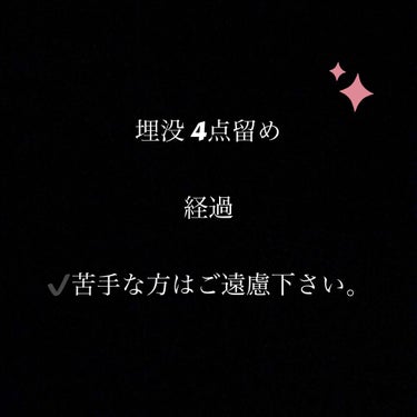 メイク動画upする前に…
私、２回、整形しております。

1回目
2011.1/3 
瞼の脂肪吸引、埋没2点留め

2回目
2018.6/17
埋没4点留め

整形当日。0日目。