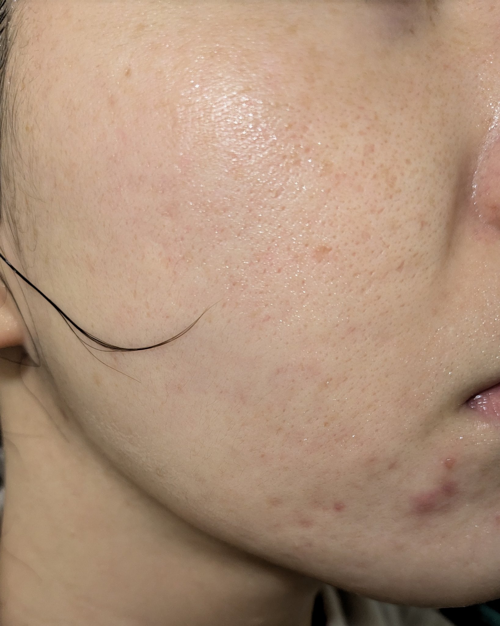 10/22の#汚肌工事録

くま？も意外とありました😱

💐肌がのためにやっていること

💊乳酸菌やビタミンサプリ:朝昼晩(昼はたまに抜かしちゃう)
💊低量ピルも飲んでます！(酷かった生理ニキビや生理痛・PMSは軽減されました)

