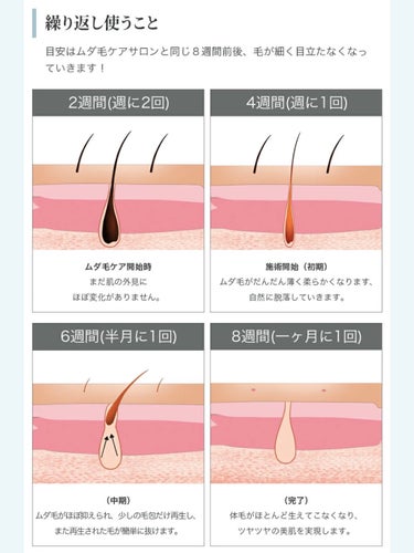 光脱毛器 VIO/Sarlisi/家庭用脱毛器を使ったクチコミ（3枚目）