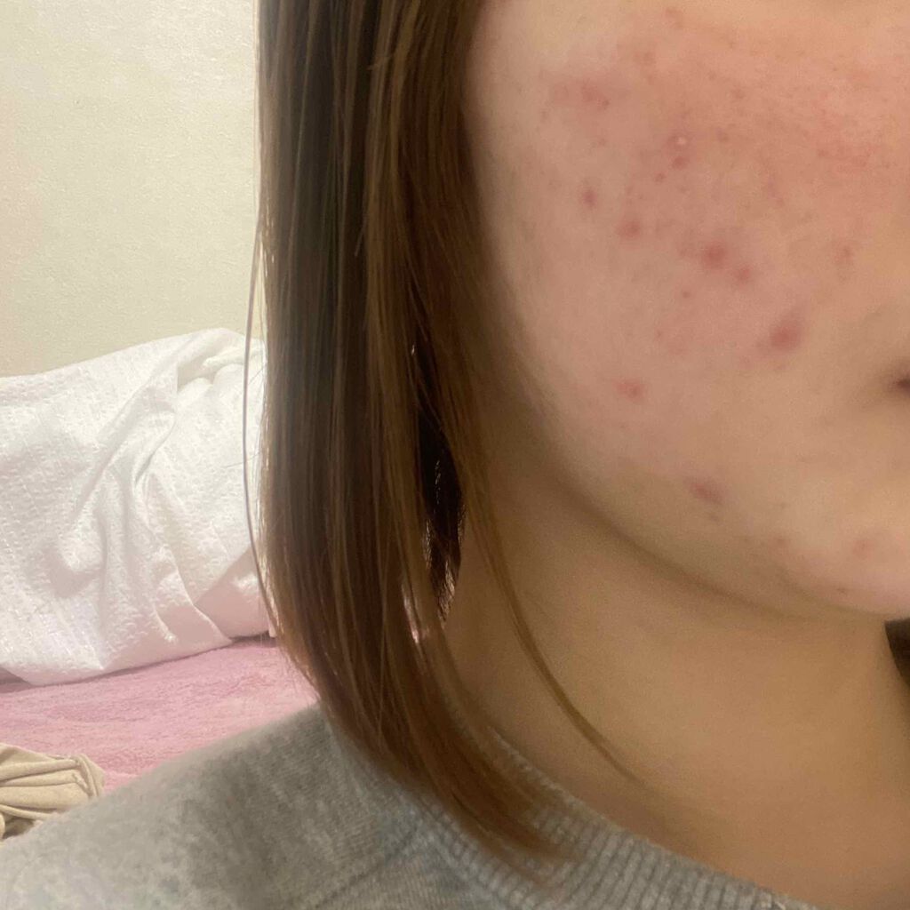 クリンダマイシンゲル(医薬品)/クラシエ薬品/その他を使ったクチコミ（1枚目）