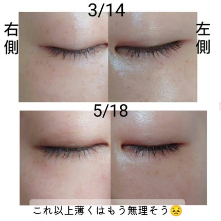 ホワイトCクリア(医薬品)/トランシーノ/その他を使ったクチコミ(2枚目)