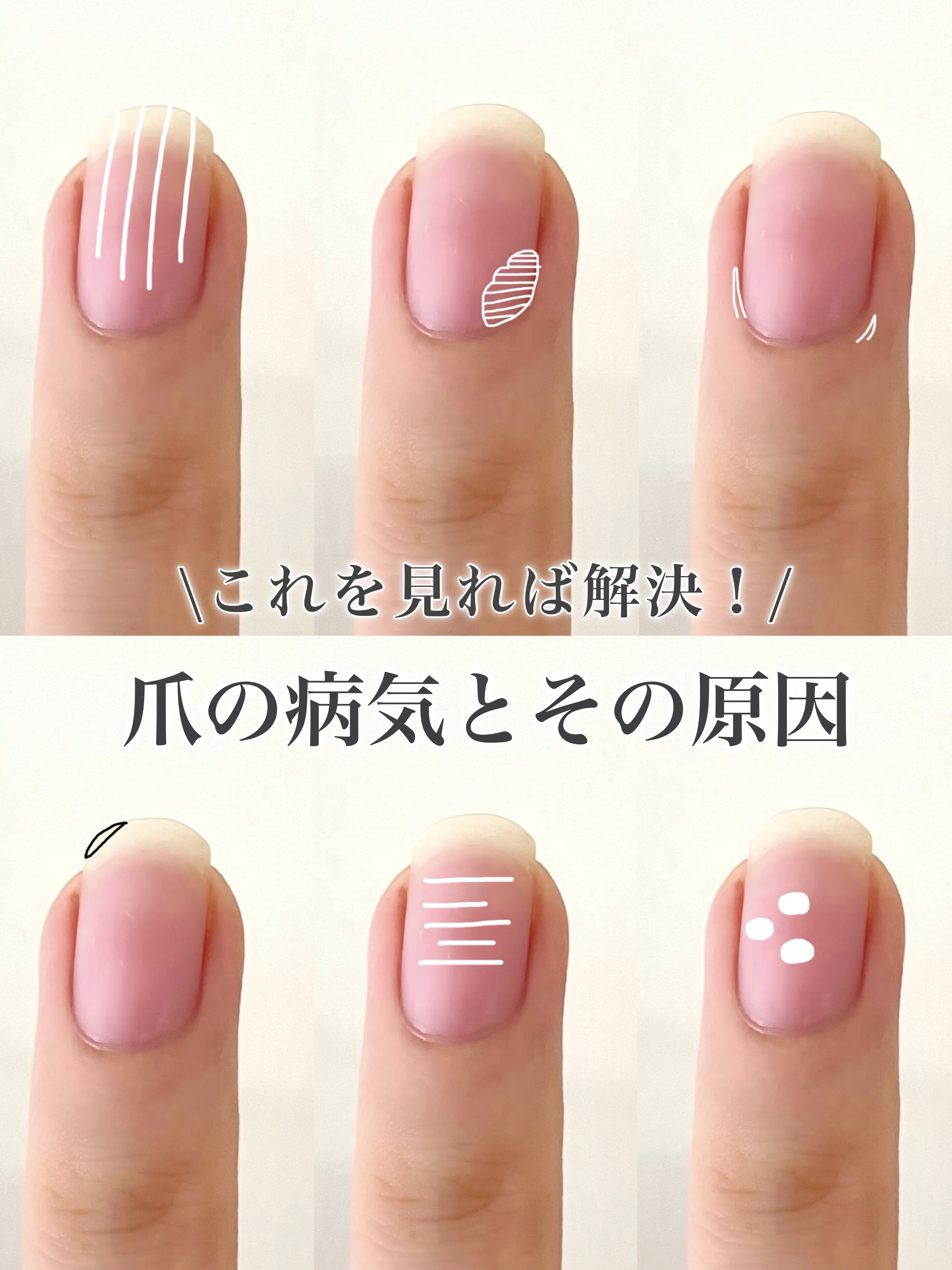 爪って意識してないとちょっとした その微妙な変化に気づけなかったりしますよね😕
 爪が出しているSOS🚨 見逃していると大変なことになるかもしれません‼️ この投稿を元に自分の手を見比べてみてください。
 今回載せている症状は比較的軽い