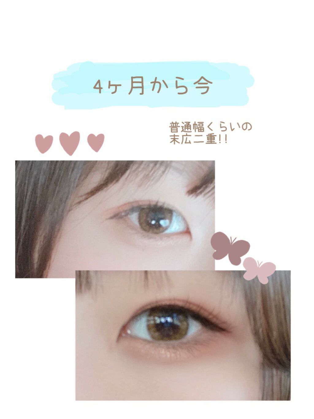 くるり on LIPS 「二重整形埋没について私は5か月前までものっっすごく重い一重でし..」(4枚目)