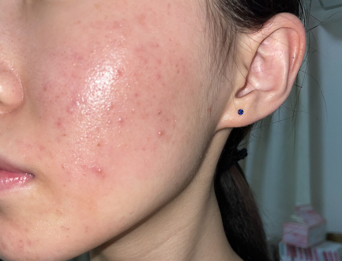 ノブ Ａ アクネソープ/NOV/洗顔石鹸を使ったクチコミ（2枚目）