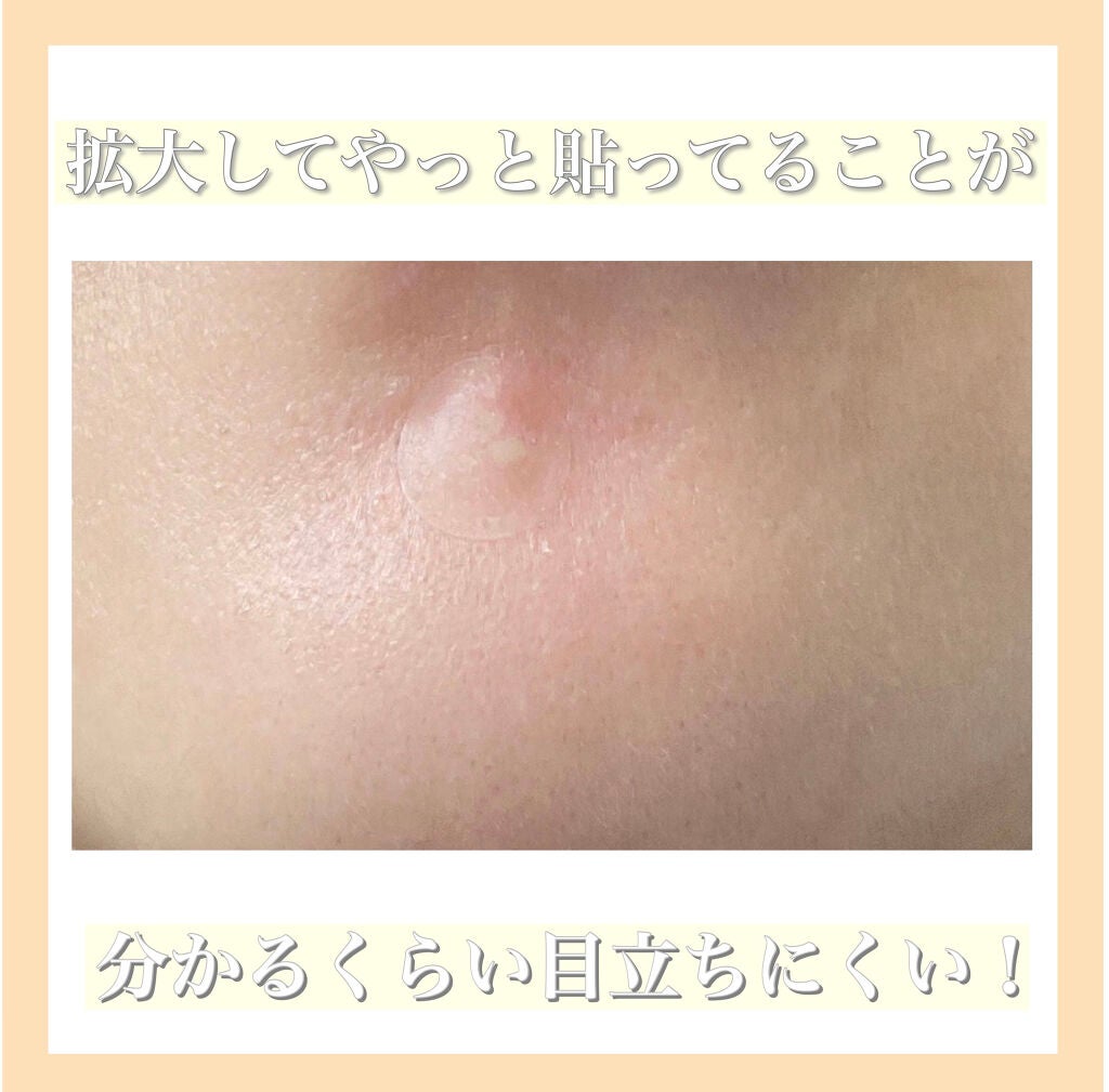 アクネピンプルマスターパッチ /COSRX/にきびパッチを使ったクチコミ(3枚目)
