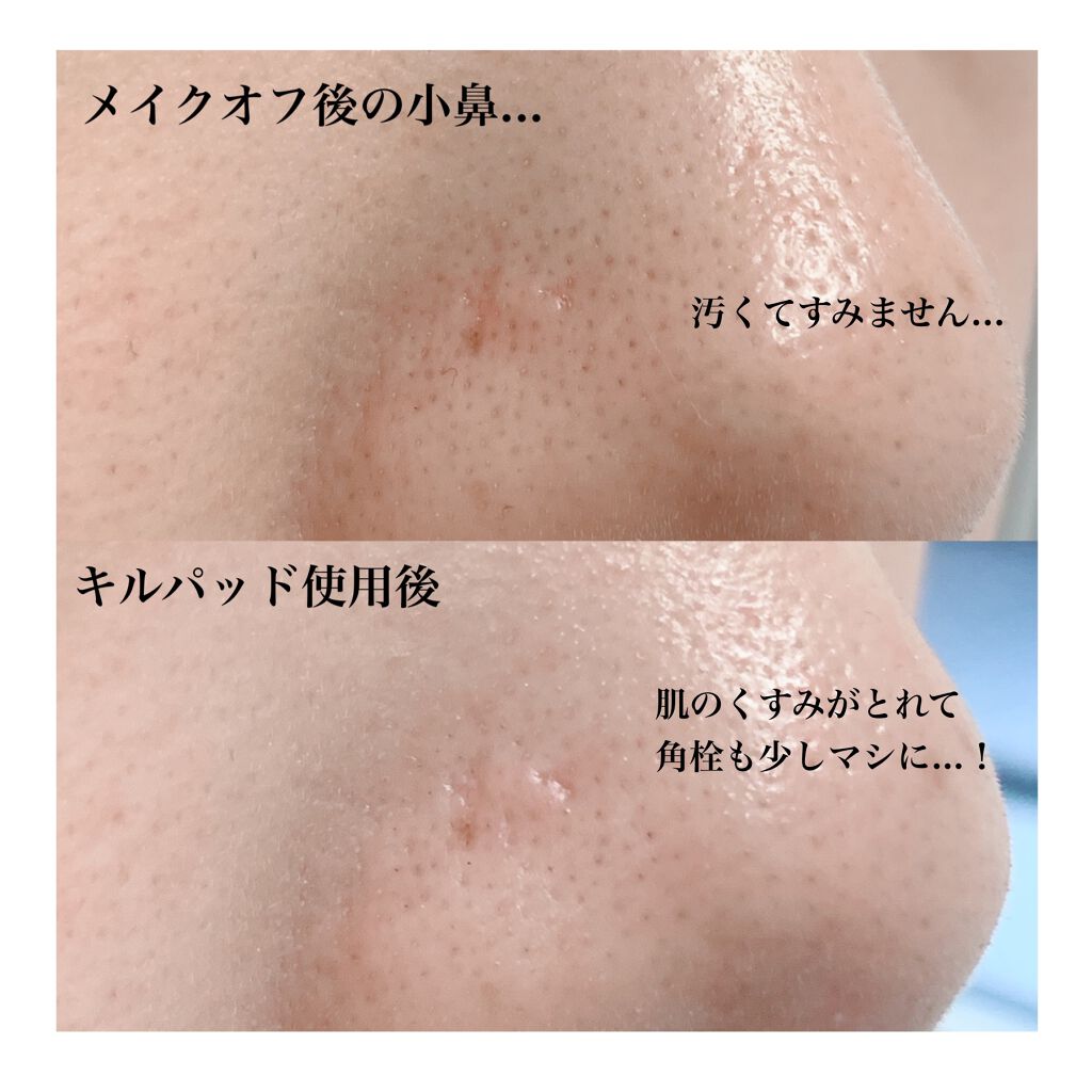 ブラックヘッド ピュア クレンジング オイル キルパッド/manyo/トナーパッドを使ったクチコミ(6枚目)