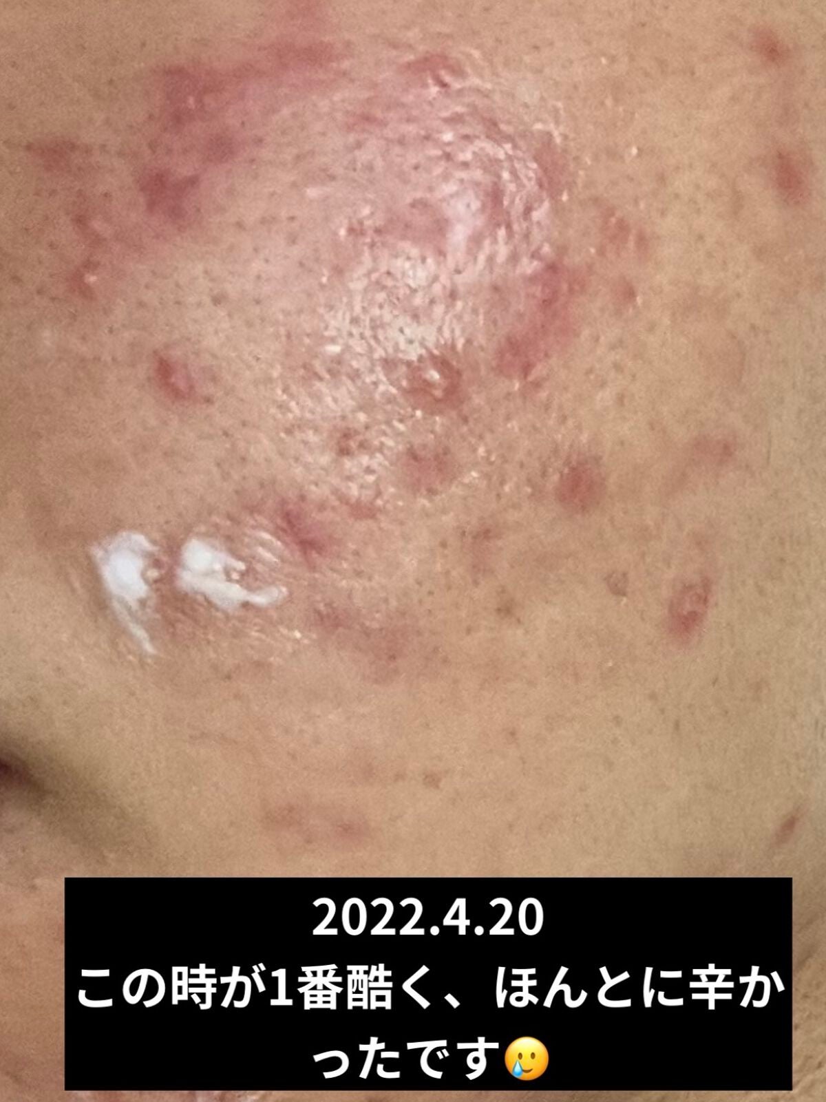 UVイデア XL プロテクショントーンアップ ローズ/ラ ロッシュ ポゼ/日焼け止めクリームを使ったクチコミ(2枚目)