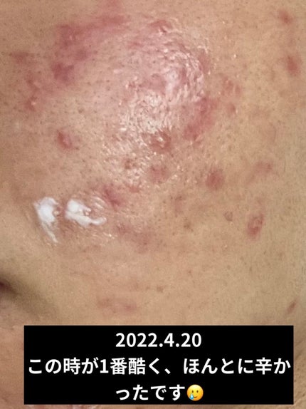 UVã€ã㢠XL ãããã¯ã·ã§ã³ããŒã³ã¢ãã ããŒãº/ã© ããã·ã¥ ããŒ/æ¥çŒãæ¢ãã¯ãªãŒã ã䜿ã£ãã¯ãã³ãïŒ2æç®ïŒ