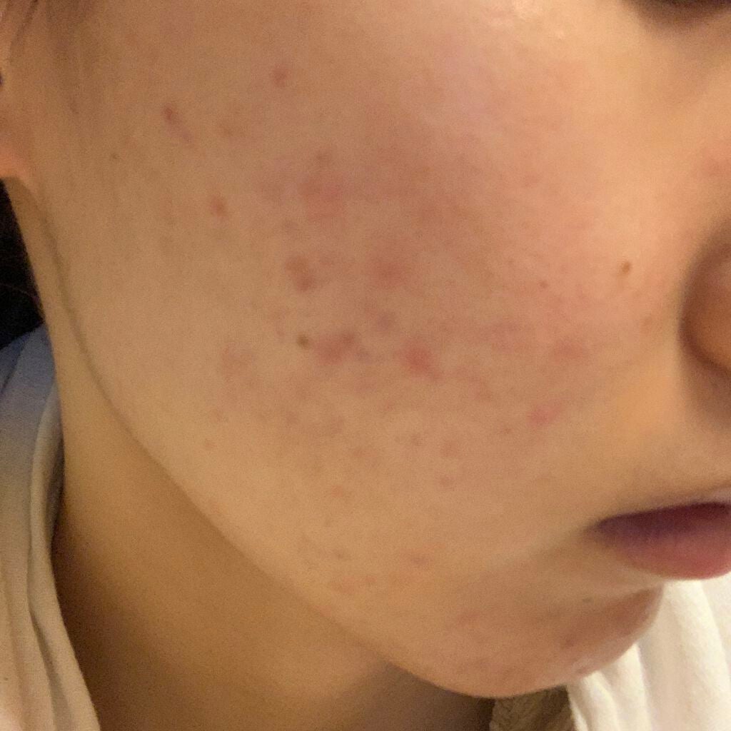 ヒルマイルドクリーム(医薬品)/健栄製薬/その他を使ったクチコミ(1枚目)