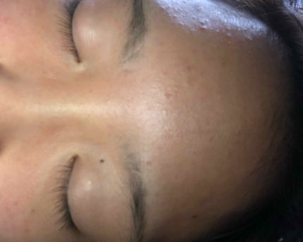 ペアアクネクリームW(医薬品)/ペア/その他を使ったクチコミ(2枚目)