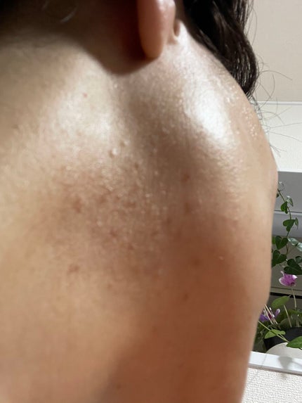 AHA 30% + BHA 2% Peeling Solution/The Ordinary/ピーリングを使ったクチコミ(4枚目)