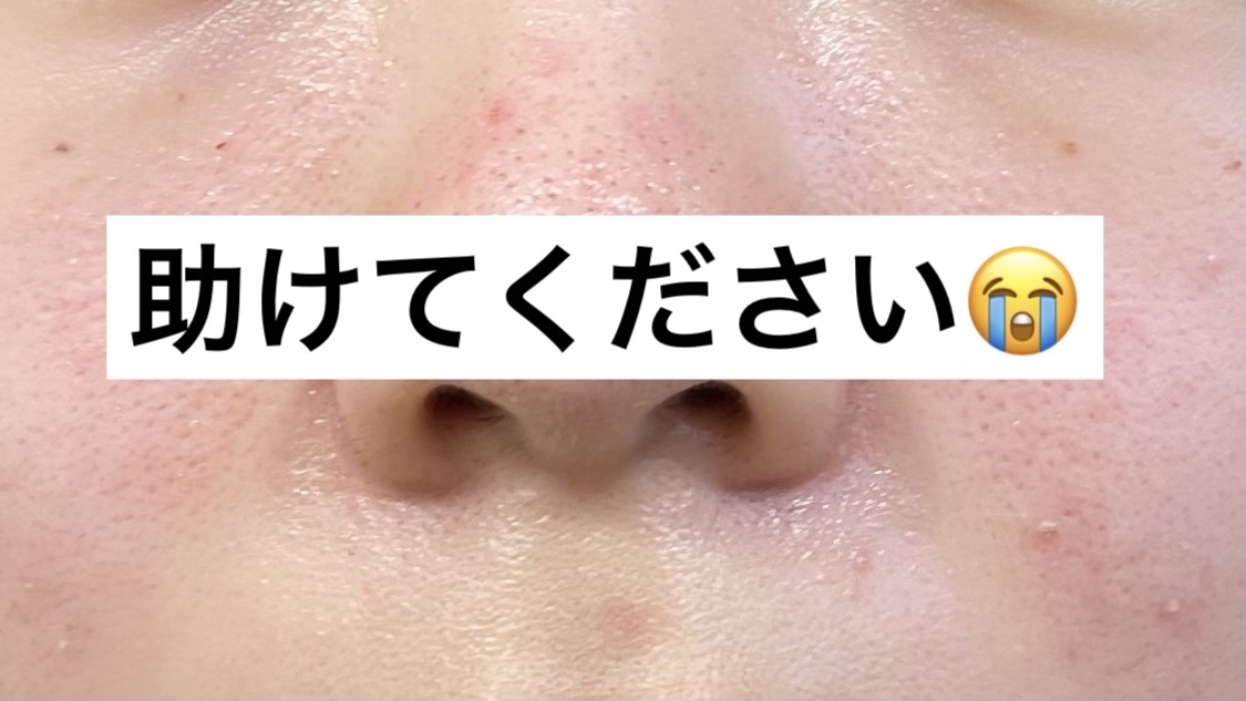 パーフェクトホイップ アクネケア/SENKA（専科）/洗顔フォームを使ったクチコミ（1枚目）