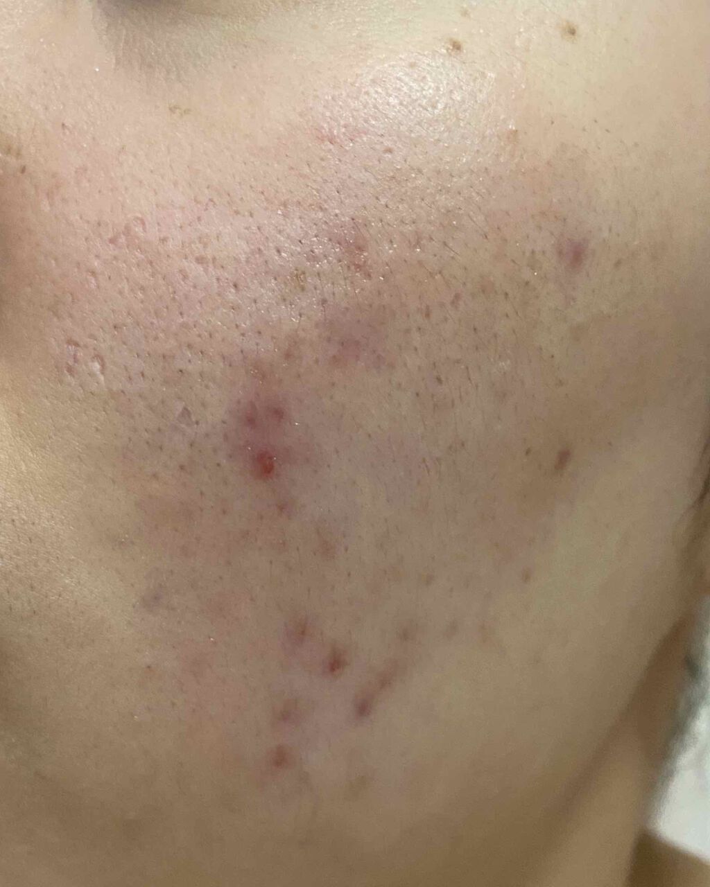 FDR アクネケア 洗顔クリーム/ファンケル/洗顔フォームを使ったクチコミ（3枚目）