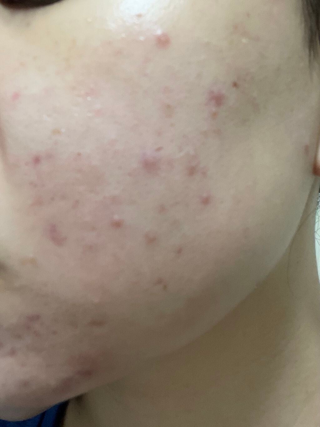 まままこ on LIPS 「ニキビゼロ肌を目指して〜8/22〜⚠️2枚目から肌画像ありスキ..」(2枚目)