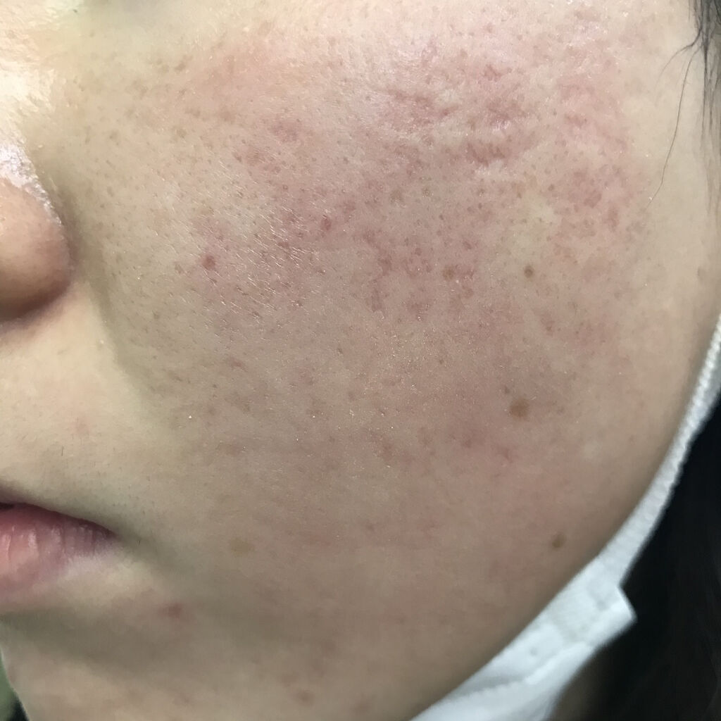 薬用 スキンケア パウダー/アクネオ/プレストパウダーを使ったクチコミ（2枚目）