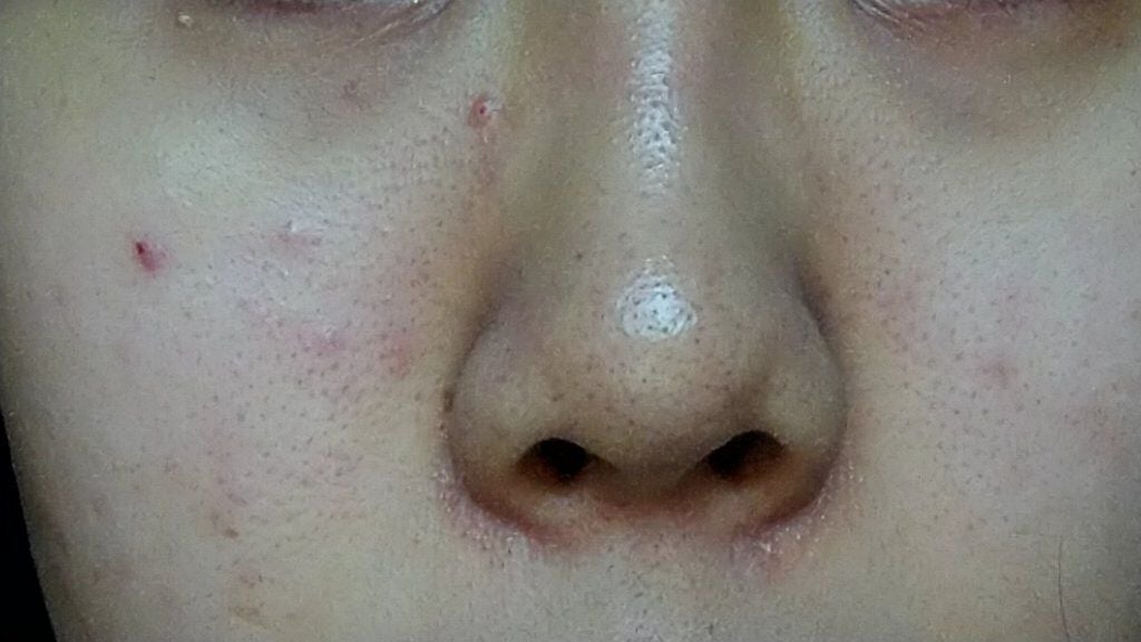 カムイ on LIPS 「#毛穴#ニキビ#黒ずみ7月までにどれかひとつでも無くしたいので..」(2枚目)