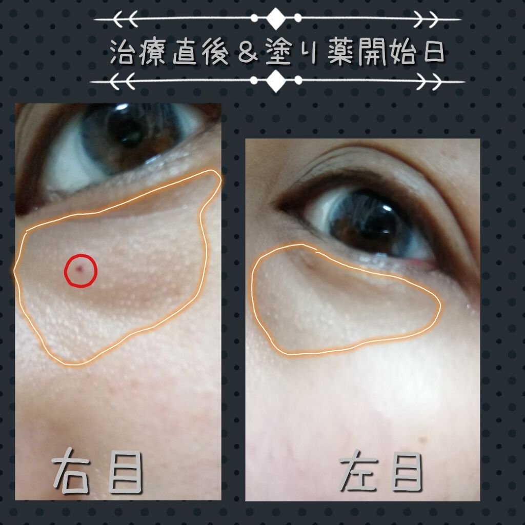 shiny_glow_fc9 on LIPS 「稗粒腫(はいりゅうしゅ)とは、1〜2mm程度の大きさで白色〜乳..」(2枚目)