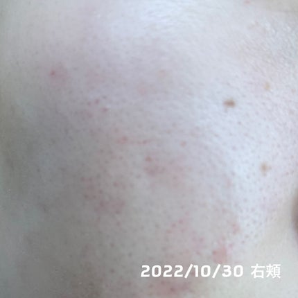 chico on LIPS 「【肌記録】ニキビはだいぶよくなってきたけど次は毛穴が気になる…..」(2枚目)