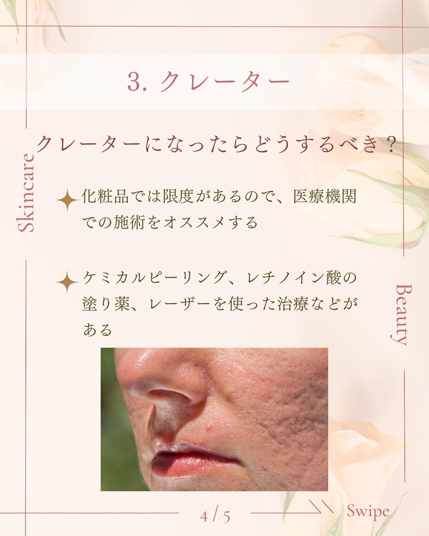 ã¿ãð¹ on LIPS ãæå€ãšç¥ããªã/ãããè·¡ã®ãæå
¥ãæ¹æ³ð¡ãããè·¡ãæ¹åãããã..ãïŒ5æç®ïŒ