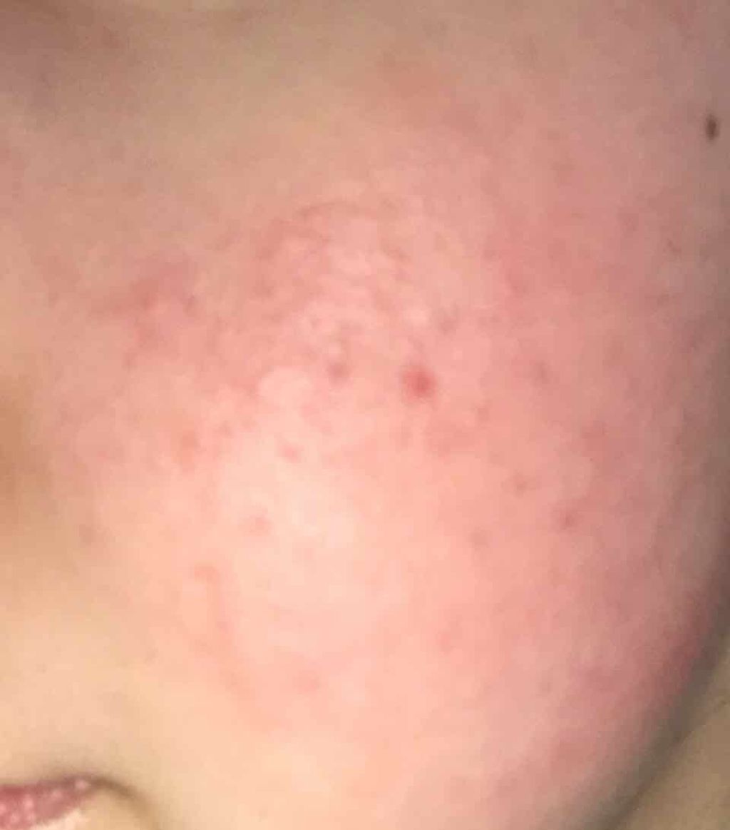 ペアアクネクリームW(医薬品)/ペア/その他を使ったクチコミ（2枚目）