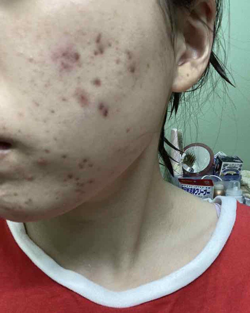 クロマイ-N軟膏（医薬品）/第一三共ヘルスケア/その他を使ったクチコミ（3枚目）