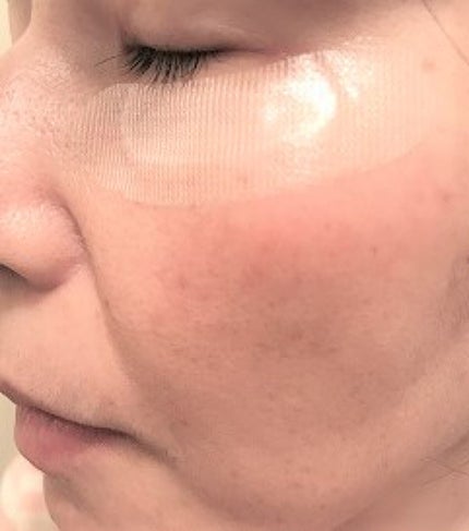 クリアターン ヒアロチューン マイクロパッチ 1500/クリアターン/シートマスク・パックを使ったクチコミ(4枚目)