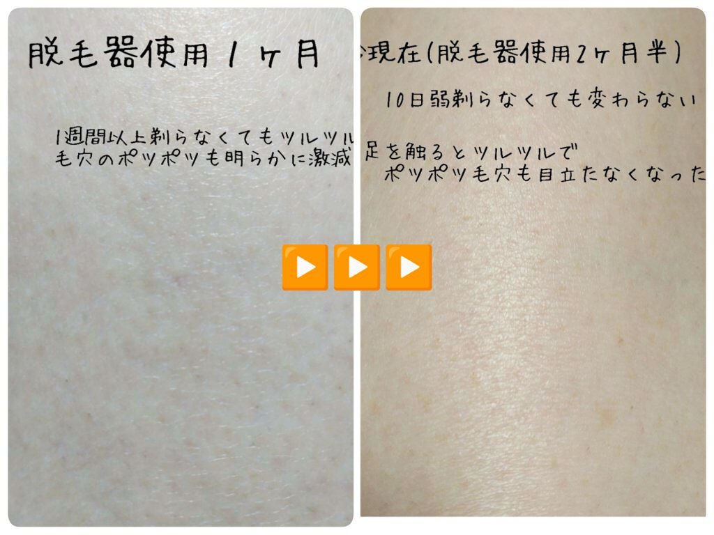 2PS/Qoo10/家庭用脱毛器を使ったクチコミ(8枚目)