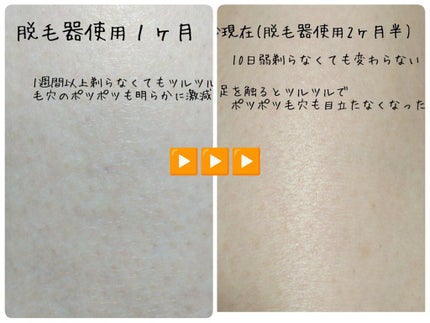 2PS/Qoo10/家庭用脱毛器を使ったクチコミ(8枚目)