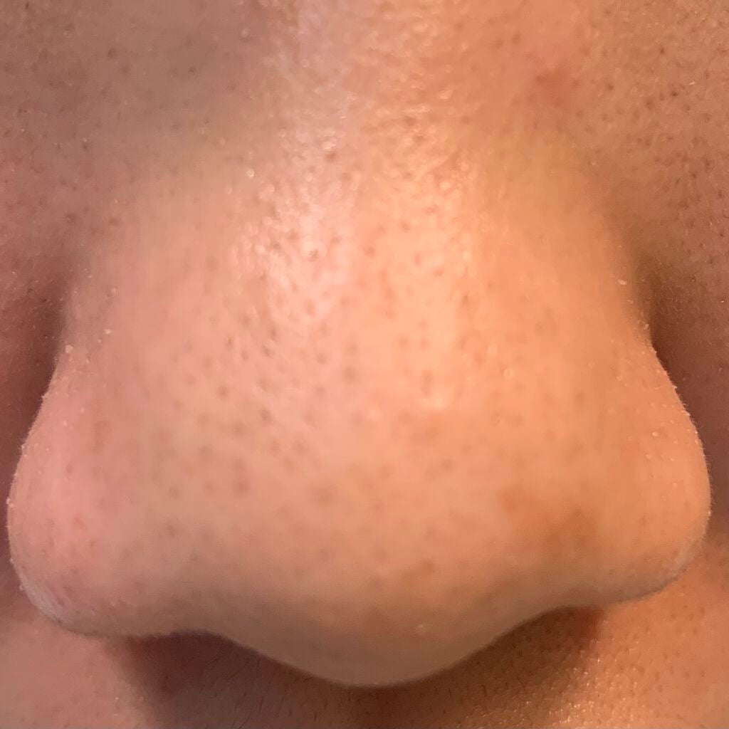 女子高校生マサトシ on LIPS 「ノーモアブラックヘッド※2枚目、3枚目の写真はノーマルで撮りま..」(2枚目)