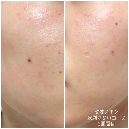 ミラミン/ZO Skin Health/フェイスクリームを使ったクチコミ(4枚目)