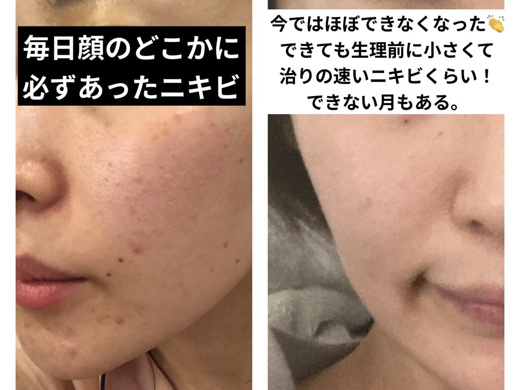 ジョンソン ベビーオイル 無香料/ジョンソンベビー/ボディオイルを使ったクチコミ（2枚目）