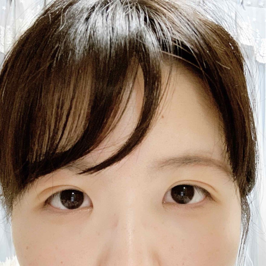 二重整形/その他を使ったクチコミ（1枚目）