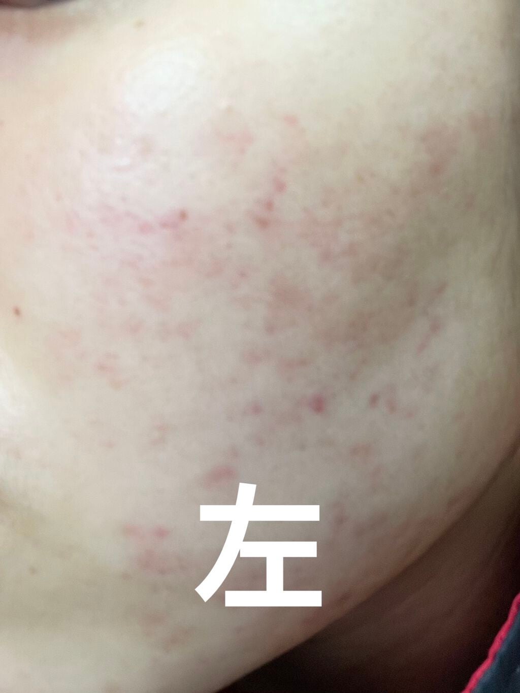 ニキビJK on LIPS 「汚肌からお肌への道!!8週間目!投稿が1日遅れてしまってすいま..」(3枚目)