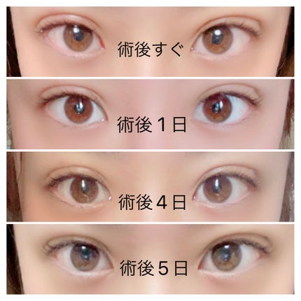 あんにんどーふ。 on LIPS 「🔥🤍🔥🤍🔥🤍🔥🤍🔥🤍私事ですが、【二重埋没法】をしてきたので記..」(4枚目)