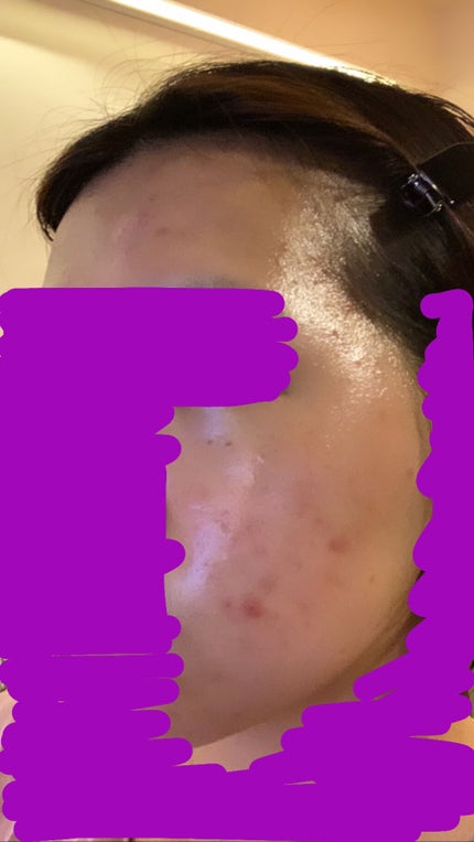 ベピオゲル/マルホ株式会社/その他を使ったクチコミ(3枚目)