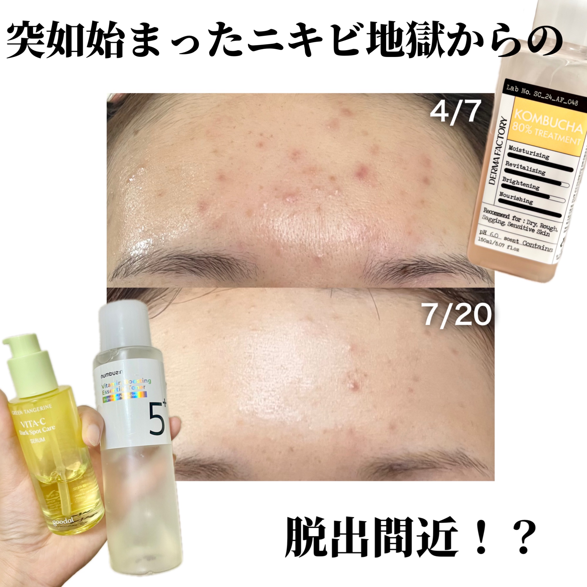 コンブチャ80%トリートメント/DERMA FACTORY/化粧水を使ったクチコミ（1枚目）