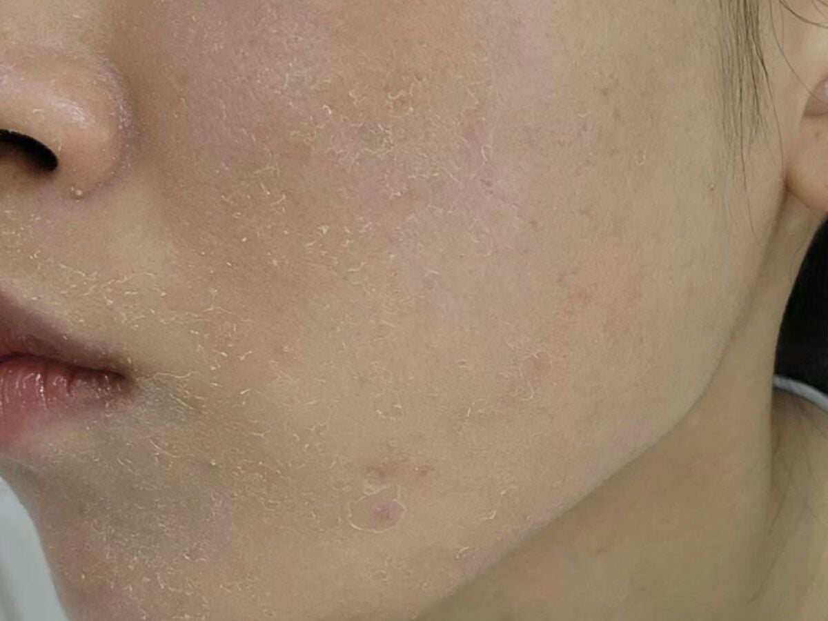 レチノールA 1% アドバンスドリバイタリゼーションクリーム/Life-flo/フェイスクリームを使ったクチコミ(7枚目)