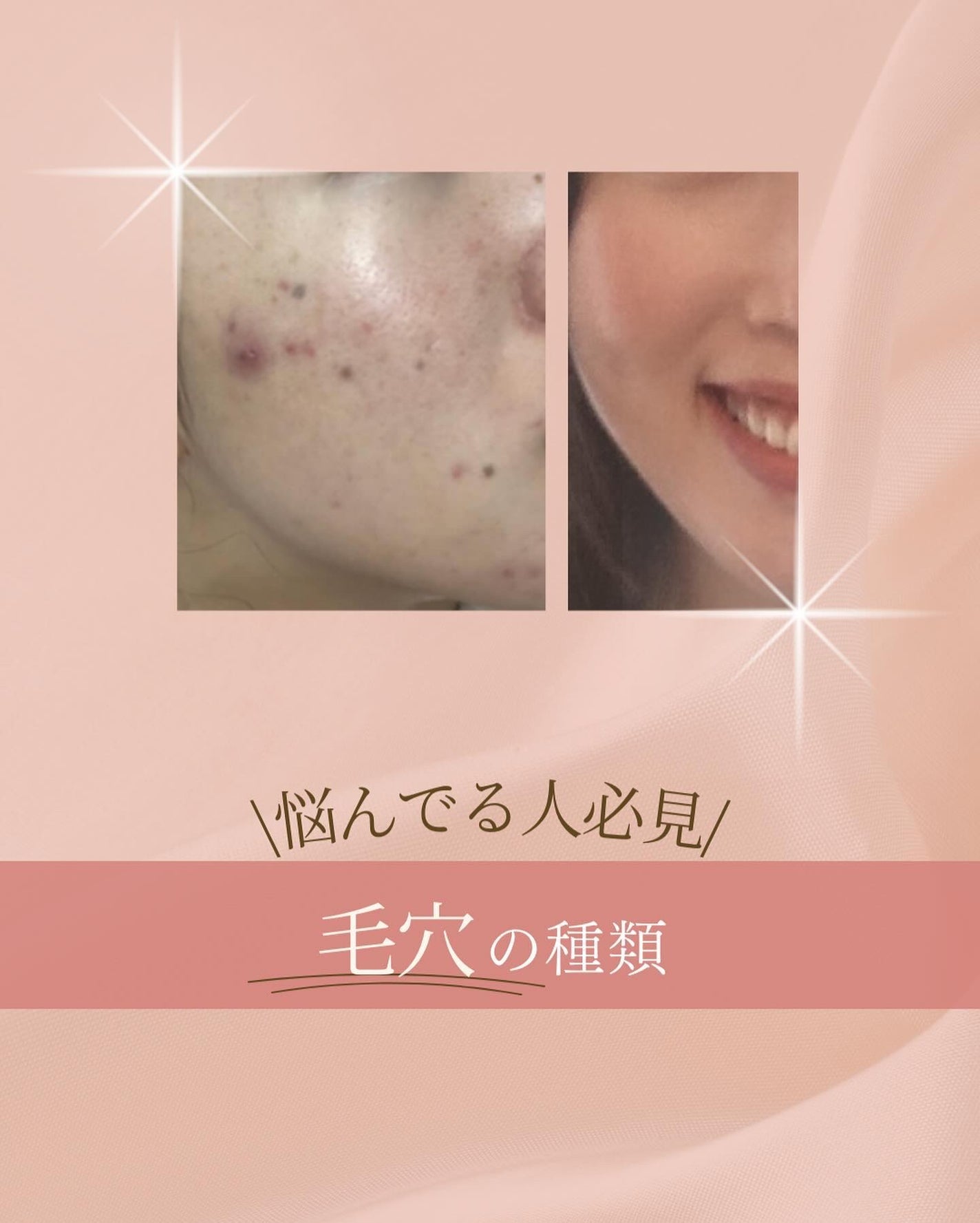 ã¿ãð¹ on LIPS ãðèæ©ã¿ã§å€ãæ¯ç©Žã®åå æ©ãã§ã人å¿
èŠ/æ¯ç©Žã®çš®é¡ð¡æå€ãšç¥ã..ãïŒ1æç®ïŒ