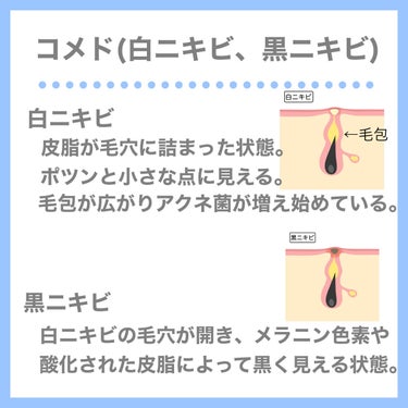 紗々🌸フォロバ100(投稿ある方) on LIPS 「ニキビ撲滅するにはまずニキビの特徴を知れということでニキビとは..」（5枚目）