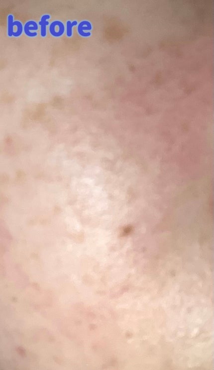 リードルショット300/VT/美容液を使ったクチコミ(7枚目)