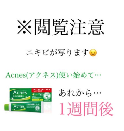 ニキビ治療薬(医薬品)/メンソレータム アクネス/その他を使ったクチコミ(1枚目)