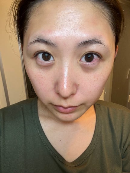 ネイチャーコンク 薬用クリアローション/ネイチャーコンク/拭き取り化粧水を使ったクチコミ(5枚目)