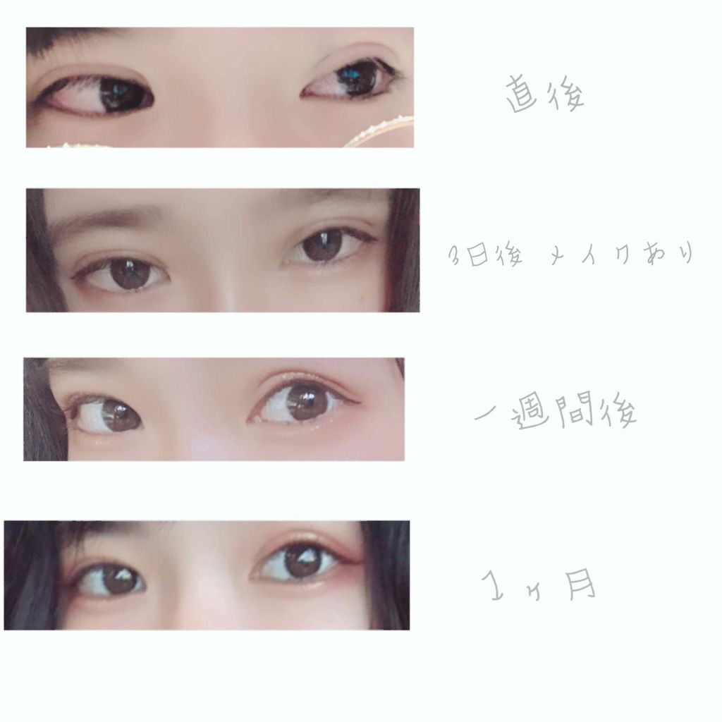 みち on LIPS 「こんにちは、最近埋没を夏休みにした方が多いみたいですねΣ(˙꒳..」(2枚目)