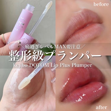 ヒアルロン酸入れた並に唇ぷっくり腫れる😂👍🏻
痛すぎる神プランパー💄🌶


keybo
DOTOM Lip Plus Plumper
グランドマスタースプリンググラス(神)


これ以上痛いプランパーってあるのかな？
なかなか出会えないと思うレベルで痛かった…

耐えれるけどこんなに痛いの初めて😂😂

口に入るとめちゃくちゃ辛くて痛いので注意⚠️

私は2度塗りしましたが、ピリピリチクチクでかなり痛い！唇の色すら結構赤くなってきたからリップ塗らなくても血色感しかない。

淡い色のリップなんて塗る意味もないくらい赤い😂

ちなみに30分経ってもほぼ変わらず。
ティッシュオフの時に化粧水を染み込ませたコットンで拭き取ったのにまだぷっくり。

この時はもう痛みとか無かった。
暫くすると慣れるのか落ち着くのか。

痛くて早くオフしたい方は化粧水染み込ませたコットンがおすすめ！冷やしながらだとよりマシになる。

はじめは1度塗りで良さそう。
ビフォー、アフターで分かりやすく撮影しようと2度塗りすると流石にたらこ唇になった( •́ɞ•̀)

結果、私は結構好きですが
唇がここまで赤くならないならもっと好き。




#keybo
#神プランパー
#リップ
#プランパー 
#整形級
#唇_縦じわ  #新入りコスメ本音レポ の画像 その0